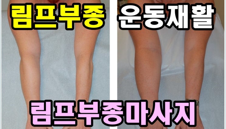 림프부종의 운동재활 림프부종마사지