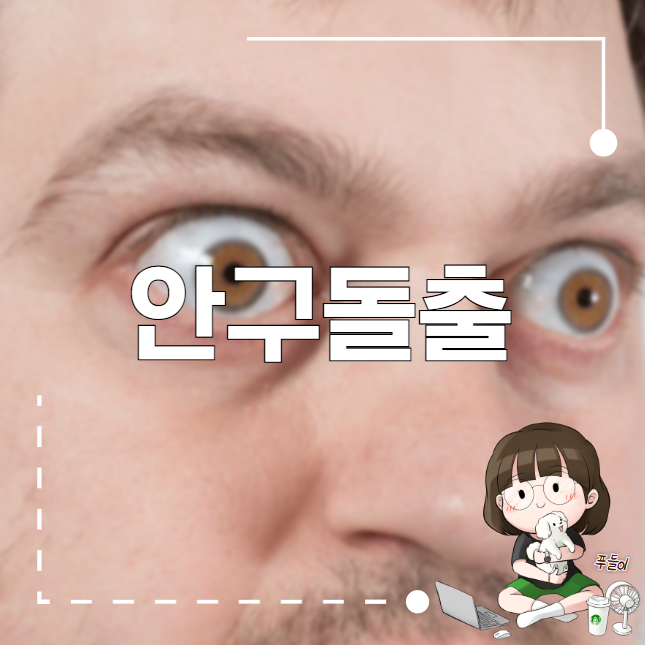 안구돌출 원인과 치료방법은 무엇일까?