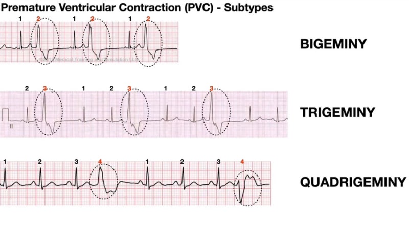 PVC 의학용어 (심실조기수축, Ectopic, Bigeminy, Trigeminy ) 개념 공부하기