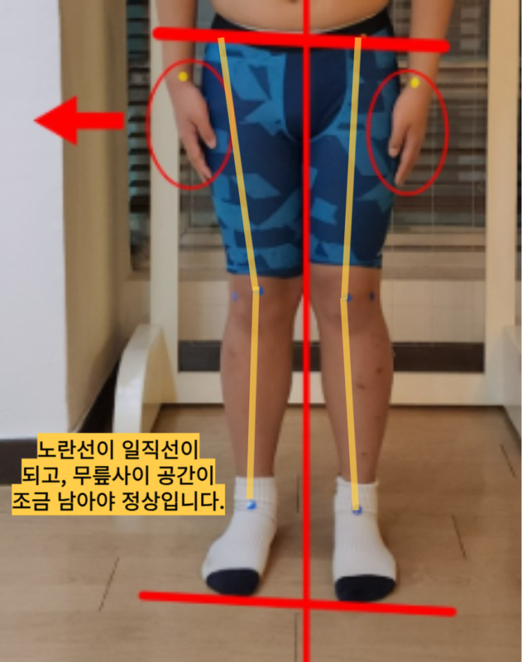 부산 동래 x자다리, 내 무릎통증이 낫지 않는 이유?