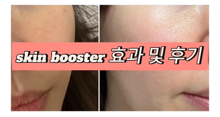  을지로입구역피부과 포텐자 콜라스터 넥소좀 효과 및 리얼후기