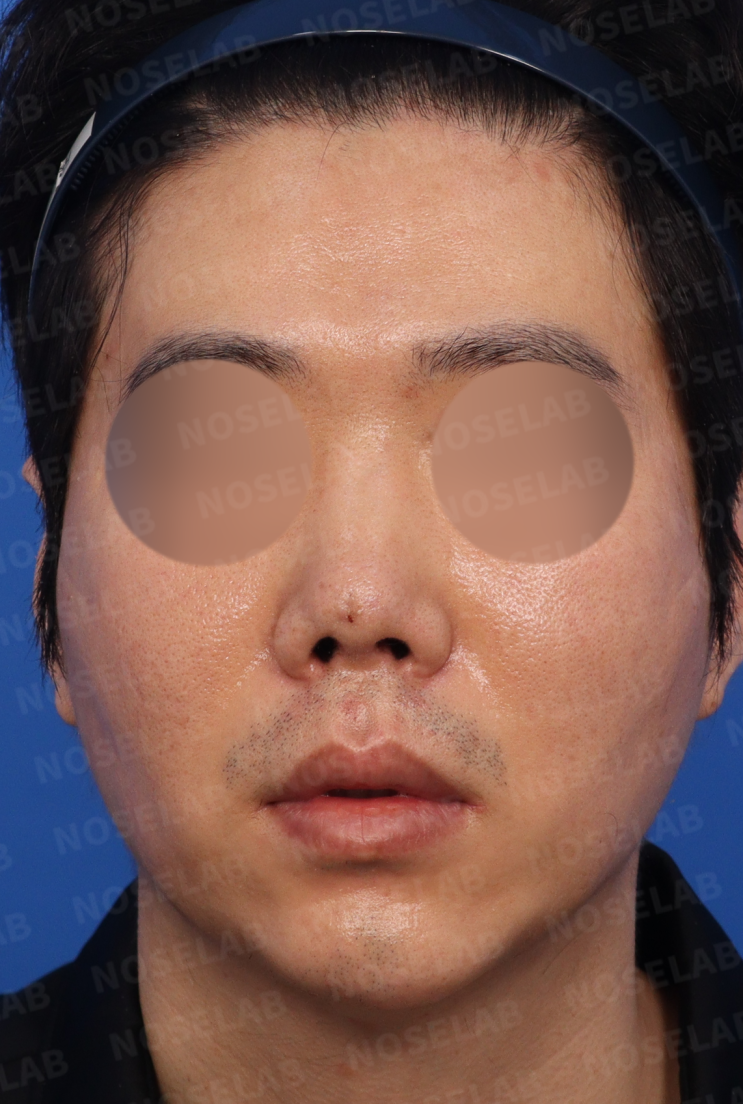  코끝 염증 재발 방지 재건술 - 찝힌 콧날개 교정 실제 후기 [노즈랩의원]