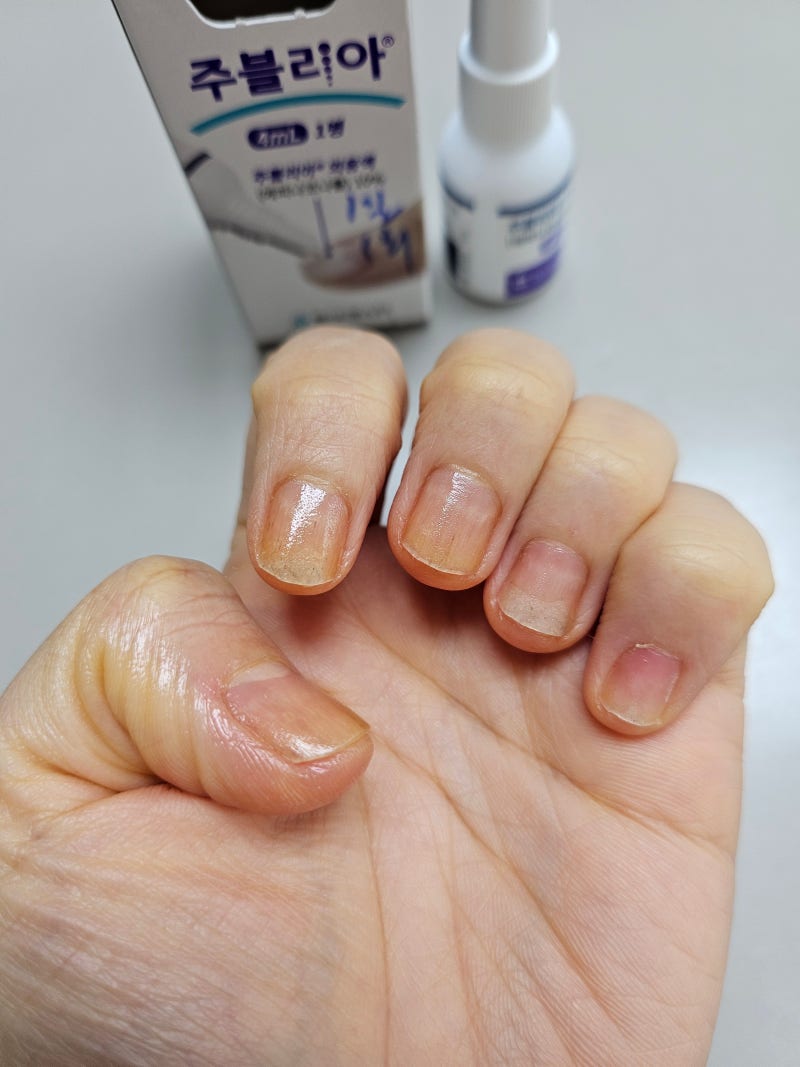 젤네일부작용 손톱무좀 치료기2탄 손톱두겹 조갑박리증 손톱진균 주블리아
