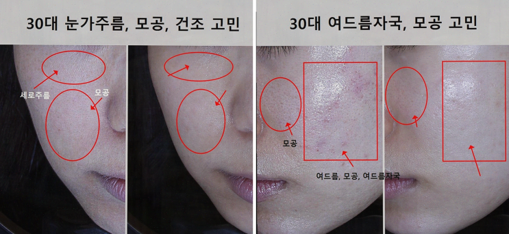  신혼부부도 만족하는 애띠애 피부 관리