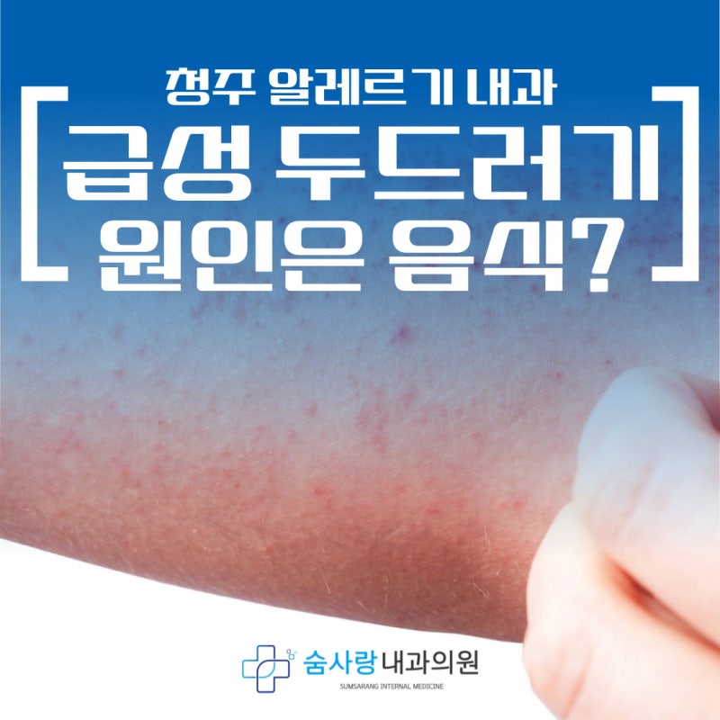 청주 알레르기 내과 급성 두드러기 원인, 음식이 문제?