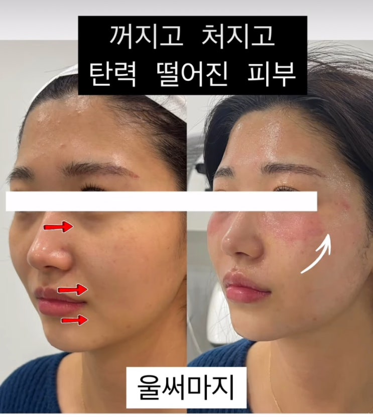  대구 남구 대명동 피부관리 울써마지의 기막힌 효과