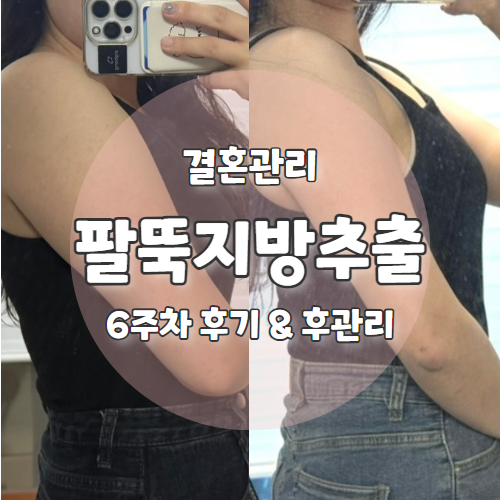  다이어트 시작 - 6주차 팔 지방추출주사 자세한 후기 웨딩 촬영 전에 변화 -5.1kg 감소