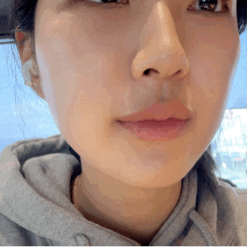  엑소좀 5cc 내돈내산 리쥬란 스킨부스터 비교 후기