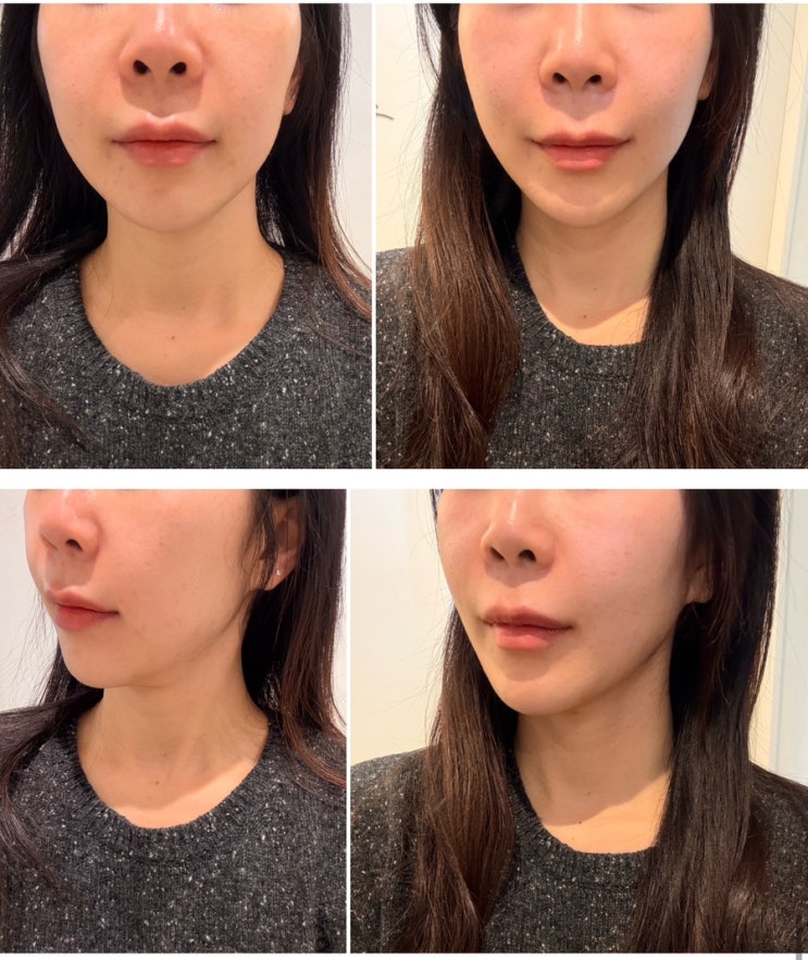  을지로피부과 온다 리프팅 2회차 후기 | 온다리프팅주기 효과