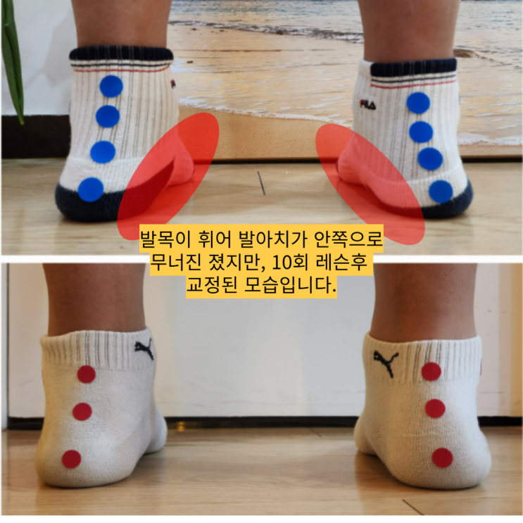  부산 소아 평발교정, 보행과 자세까지 바로잡는 곳