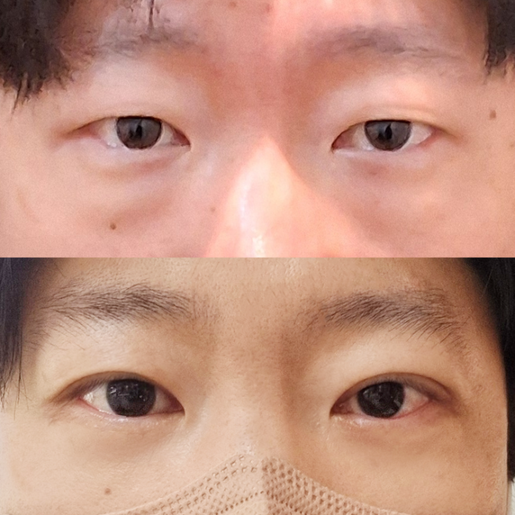  남자 눈밑지방재배치 수술과 용기에 대하여