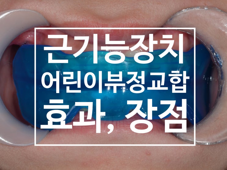 프리올소, 이에프라인, 코이 (근기능장치)의 효과, 장점, 및 활용 방법 프리올소, 이에프라인, 코이 (근기능장치)의 효과, 장점, 및 활용 방법