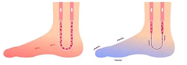  다리 혈액순환 안될때 나타나는 증상