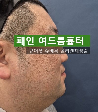  큐어젯 쥬베룩 볼라썸 리투오 여드름흉터 진피재생술 최강 조합은? (아르네 원장직접작성)