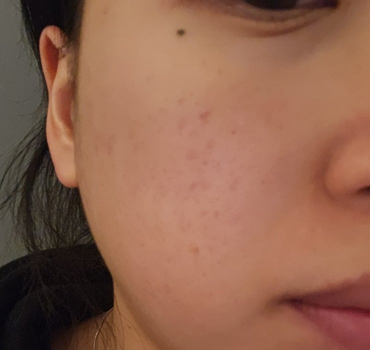  주근깨, 기미, 잡티에 효과적인 피코토닝레이저 6회차 찐후기 와 산소필 과 수분초음파 관리