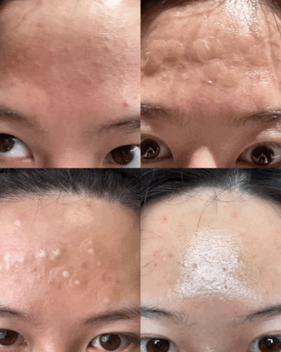 용산 한남동 피부과 여드름 올인원레이저 시술 경과 후기 용산 한남동 피부과 여드름 올인원레이저 시술 경과 후기