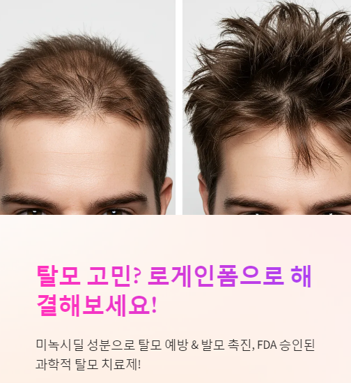  로게인폼(Rogaine Foam) 완벽 정리! 효과, 사용법, 부작용까지