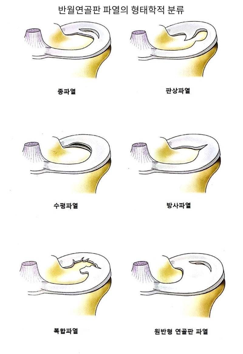 무릎 안쪽반달연골 손상이 더 위험한 진짜 이유 4가지!