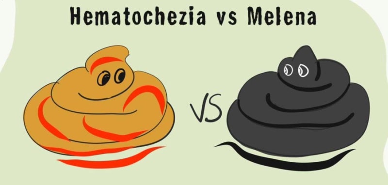 Hematochezia vs Melena 의학용어 혈변 차이 공부하기