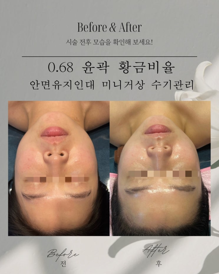  동래피부 윤곽 관리 0.68  황금 비율  관리