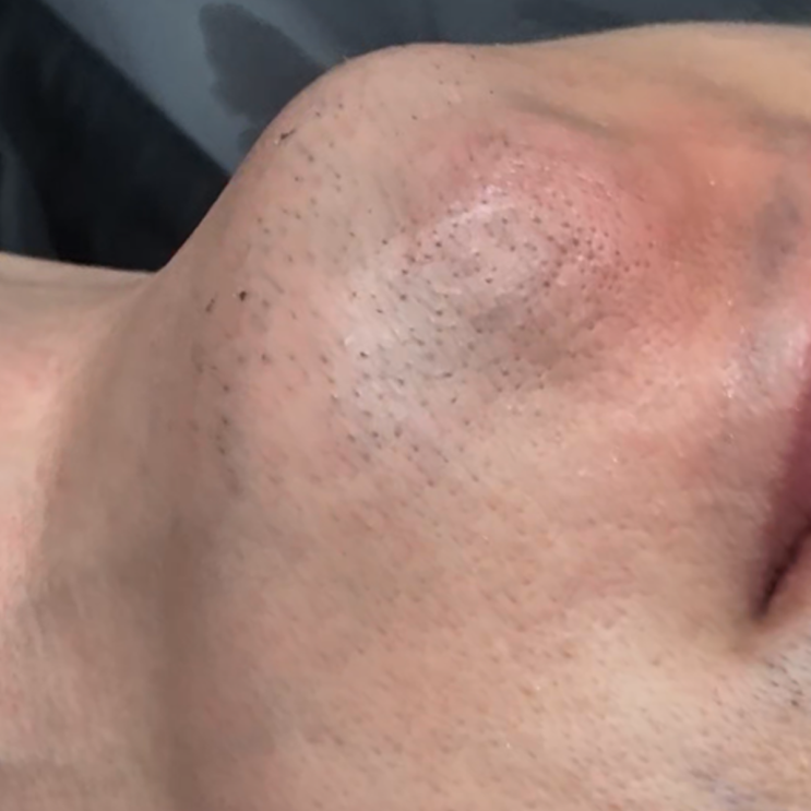  서울숲 레이저제모 후기: 강한 Laser로 조사한다면
