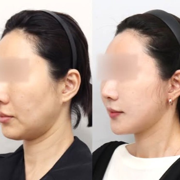 포타니딘 턱선 때문에 선택한 후기