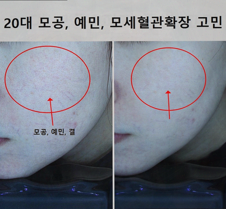  수원피부관리 애띠애에서의 특별한 기념일 피부 관리