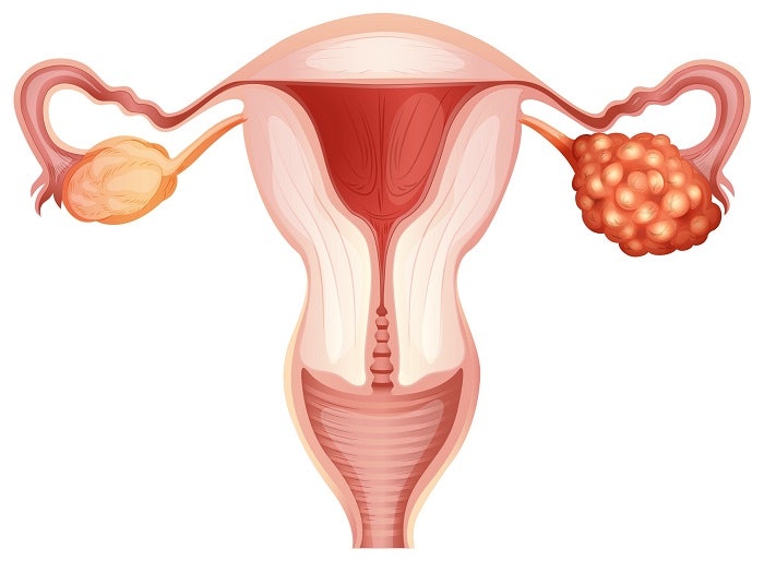 재발 X 가임력 O ‘난소 자궁내막종’ 비수술 치료