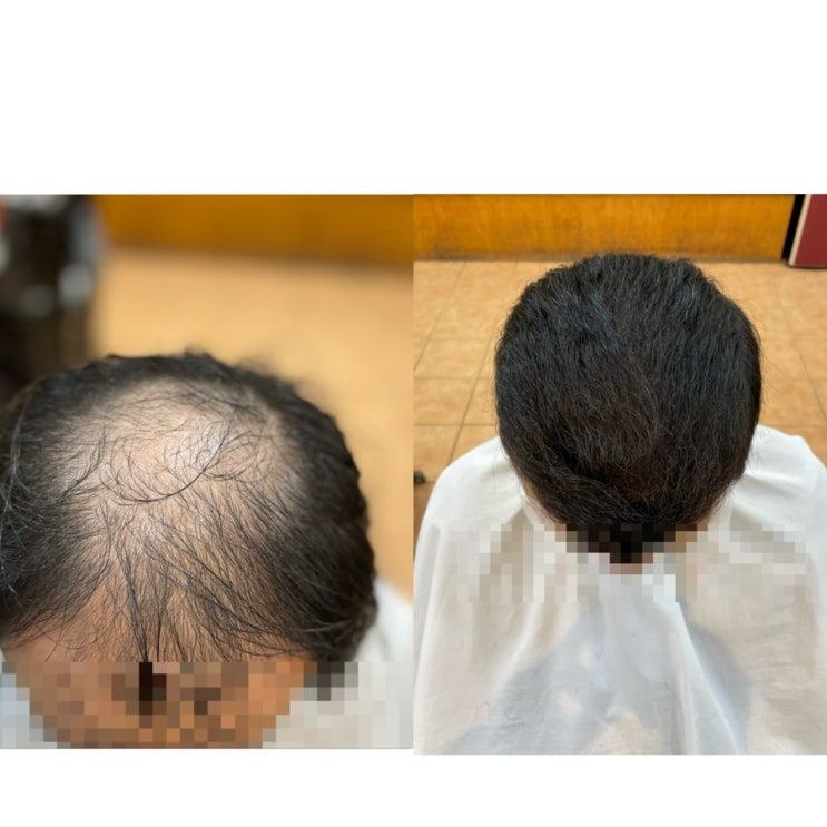  대머리남자탈모 리얼대변신 부산사상구추천미용실 머리잘하는탈모커버펌헤어스타일르네시떼헤어숍탈모컷에서펌염색복구클리닉두피케어탈모케어원스톱 원탑관리