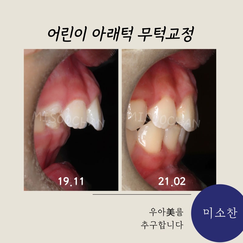 과개교합 어린이 무턱교정(소아 아래턱 교정, 전후, 비용, 기간)
