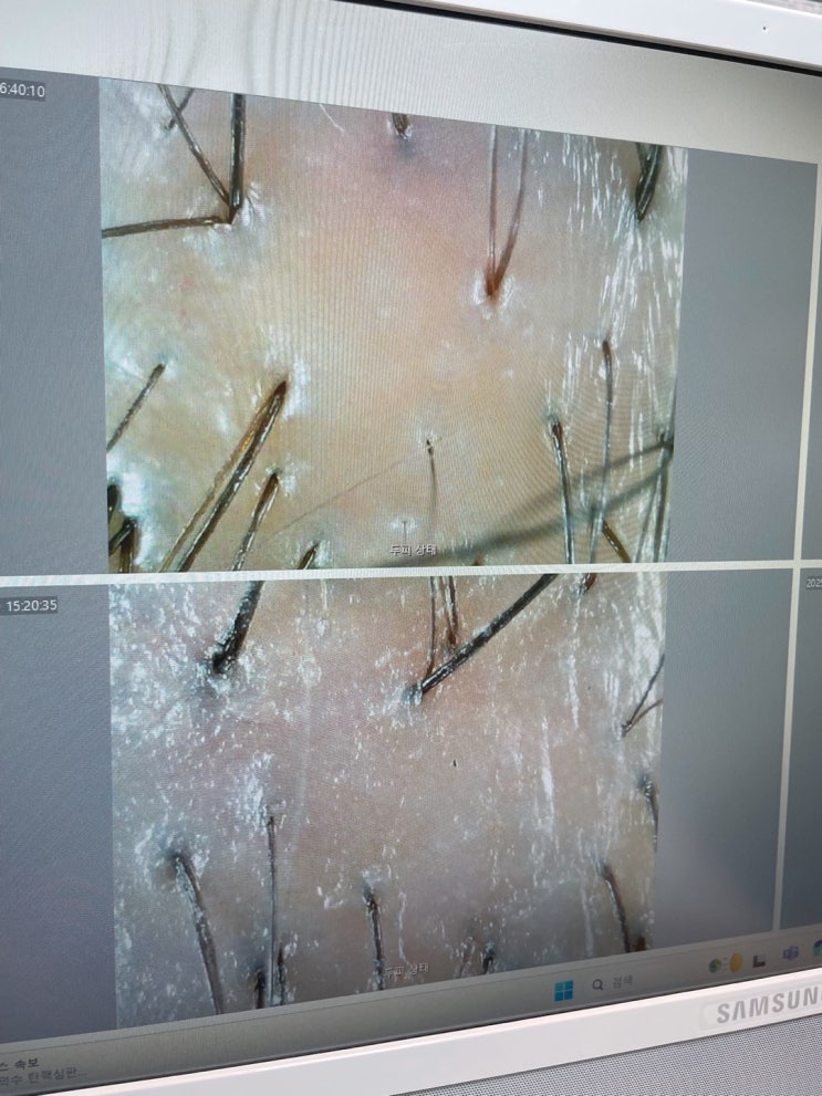  부산 동래 두피관리 더노블메디센터 두피열과 유분기 케어