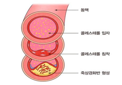 한국인의 사망원인 2위, 심혈관질환(협심증,심근경색,급성심근경색 차이점,발생원인,예방법.....