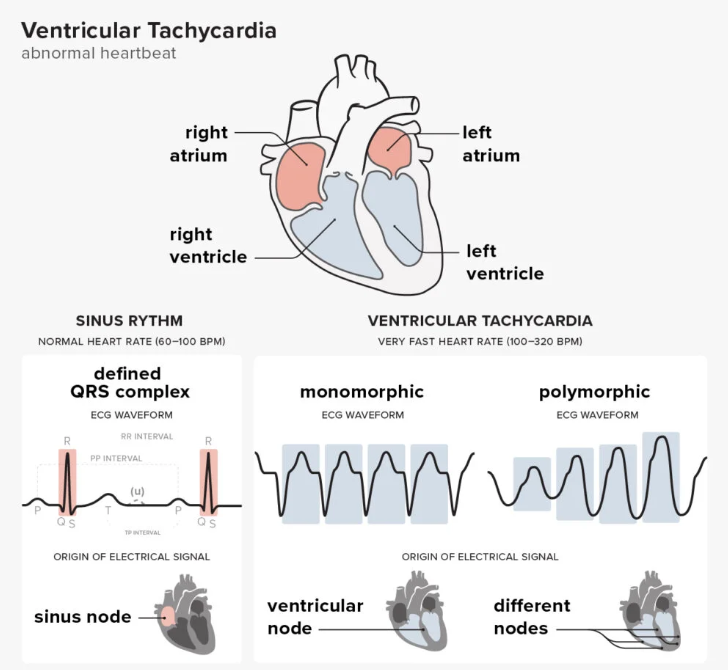 Ventricular tachycardia, 심실빈맥