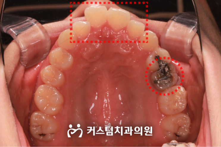  부천충치치료 통증을 느껴야만 내원해야 할까요