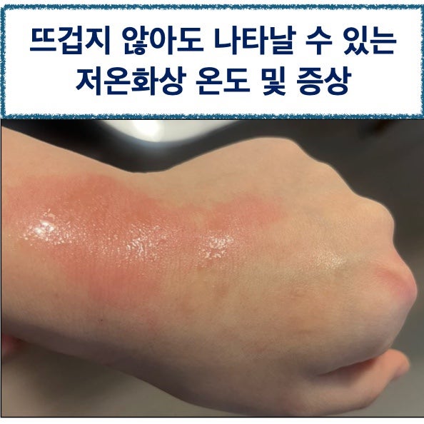 뜨겁지 않아도 화상? 저온화상의 온도와 증상