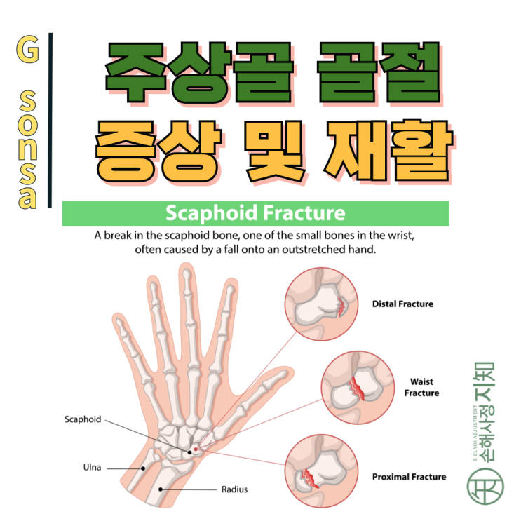  주상골 골절, 작지만 위험한 손목 뼈의 부상 완전 가이드 - [상해정보, AlDa]