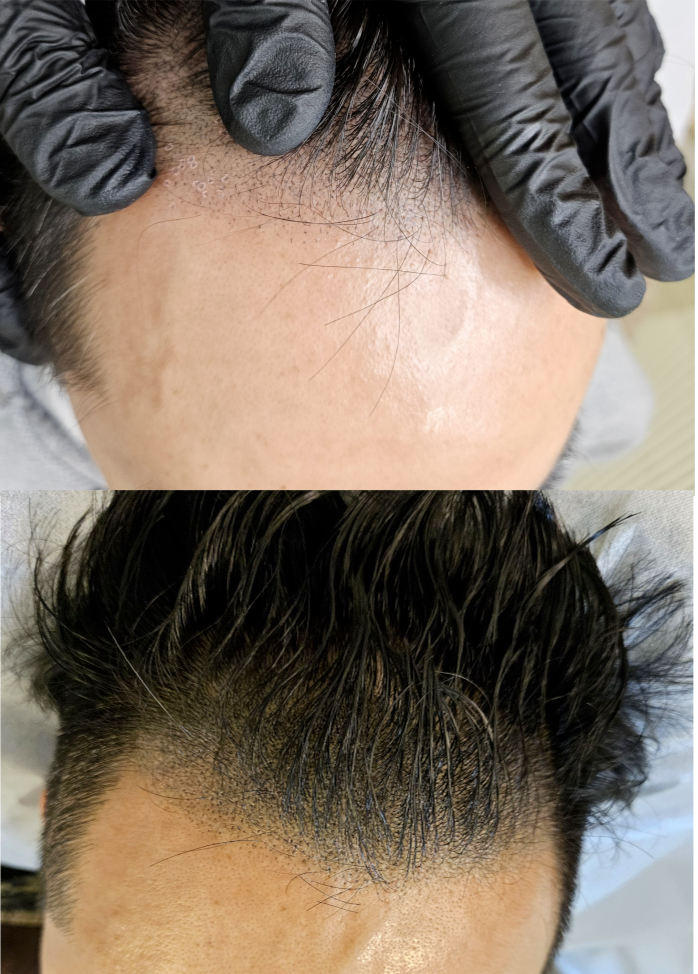 광교탈모 관리 닷센스 용인광교점 M자 헤어라인 커버 후기 광교탈모 관리 닷센스 용인광교점 M자 헤어라인 커버 후기