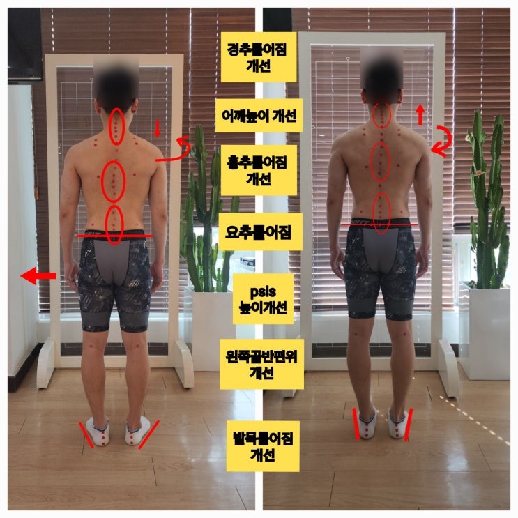 [동래 사직동 자세교정] 운동중 통증과 불균형, 한달 후 비포에프터