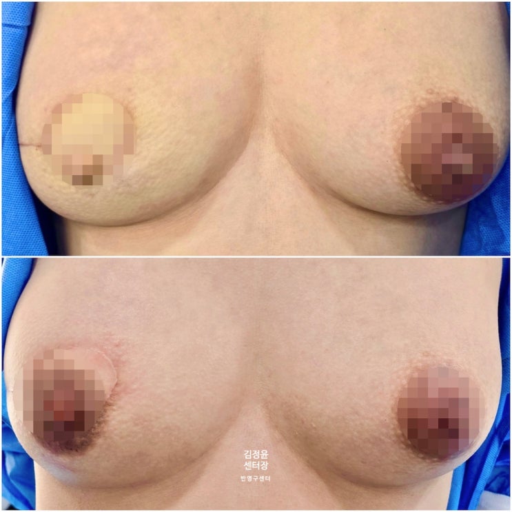  유방암 한쪽 가슴 제거 수술 후 유륜 유두 재건 3D 타투