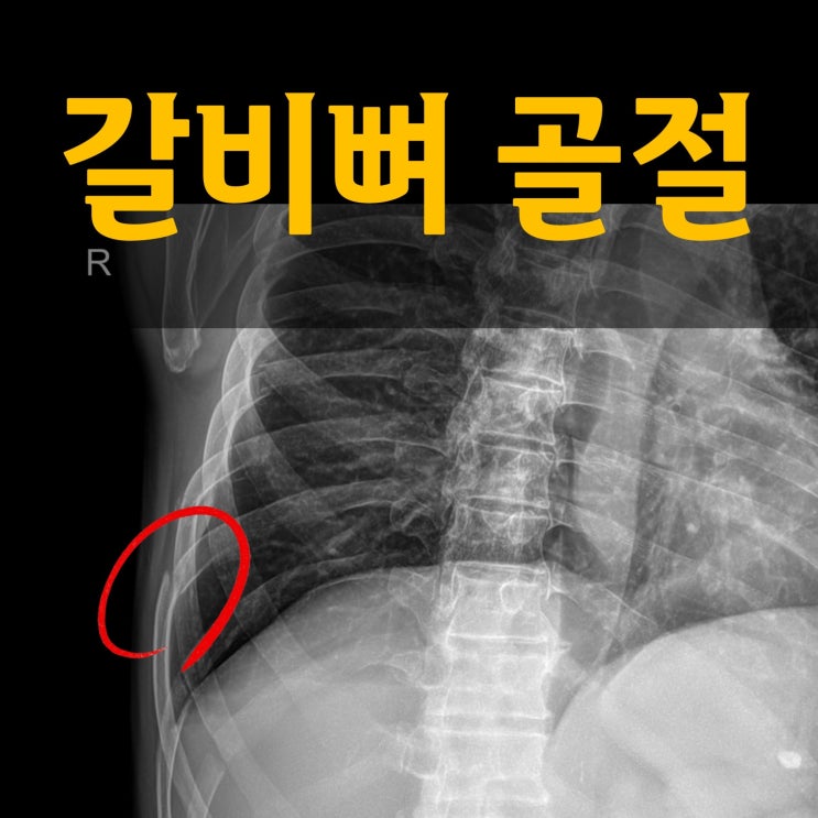  갈비뼈 골절 위험한 증상과 회복을 위한 방법은
