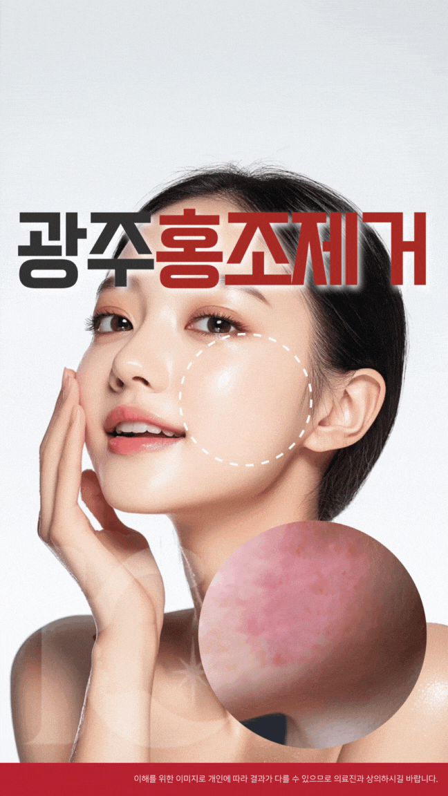  광주안면홍조 깔끔하게 치료하려면 혈관레이저 알아볼까