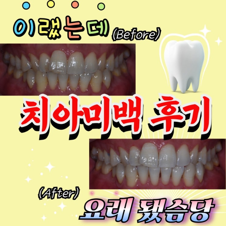  강남역 치과 첫 치아미백 솔직..한 후기 (+ 소요시간, 가격, 지속기간, 보험적용?)