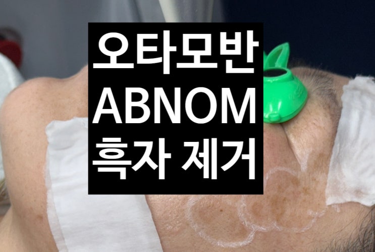  오타모반 루비레이저 치료 후천성양측 ABNOM 아르네의원