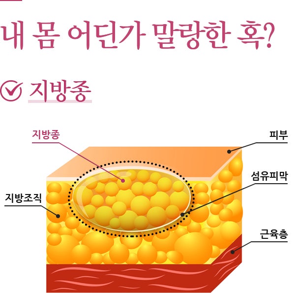 지방종, 꼭 제거해야 하는 건가요?