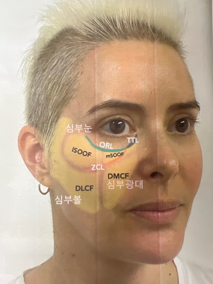  명륜동 필러존 리프팅관리
