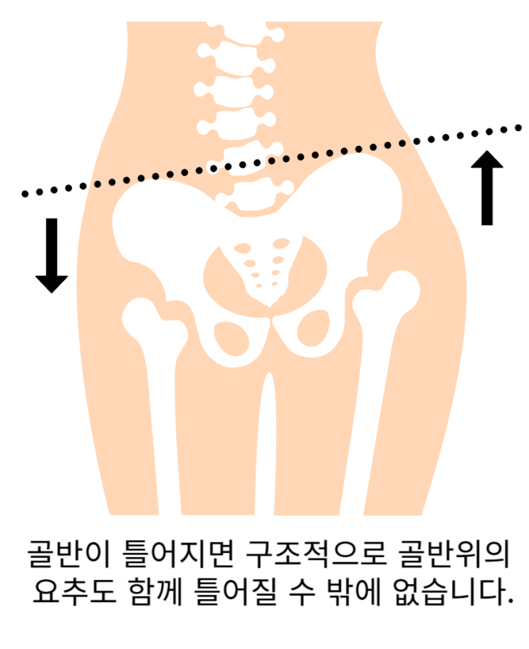  [동래 사직동 허리통증] 허리통증 원인? 골반틀어짐부터 봐야 하는 이유