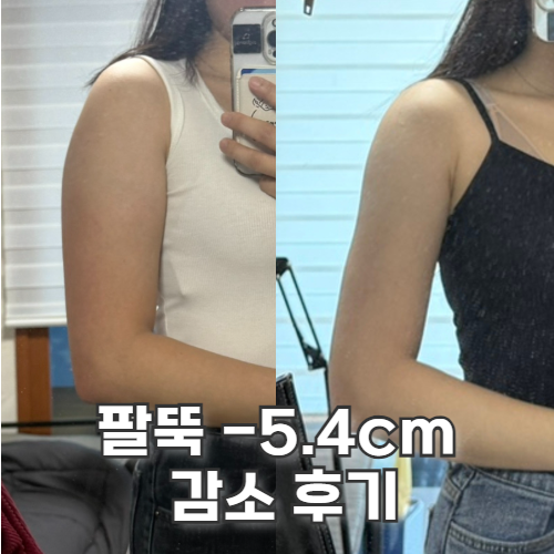  교대 비만클리닉 팔뚝 지방추출주사 팔뚝 살들 정리 후기