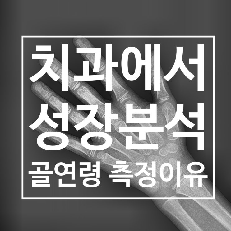 치과에서 성장분석? 손 엑스레이(수완부방사선 사진)를 치과에서 분석하는 이유? 치과교정과에서의 활용 치과에서 성장분석? 손 엑스레이(수완부방사선 사진)를 치과에서 분석하는 이유? 치과교정과에서의 활용