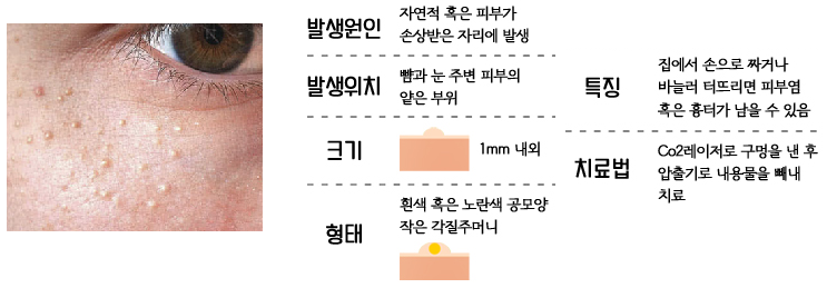 피부/쥐젖 vs 비립종