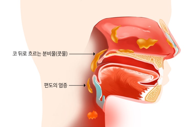  후 비르 증후군의 원인